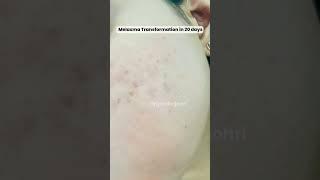 Dark Spot Treatment in 20 days #Melasma Skinfinity Derma