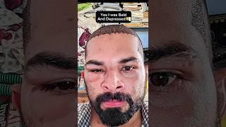 My Hair Transplant Results 99524 19890#ameerht #hairtransplant #hairlosstreatment