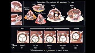 Echocardiographic Assessment of Prosthetic Valves