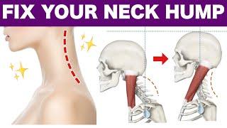 How to Fix a Neck Hump and Slim Facecan be done while standing