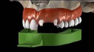 Bridge Porcelain Anterior