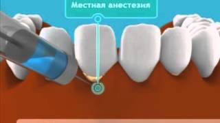 Лоскутная операция на десне